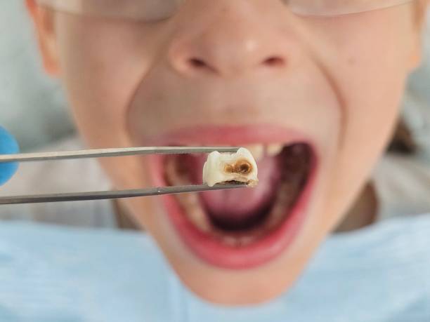 Best Emergency Tooth Extraction in Negaunee, MI